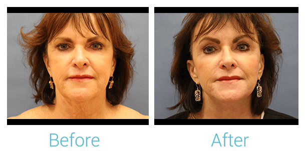 Facelift