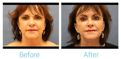 Facelift Before & After Gallery - Patient 58152101 - Image 1