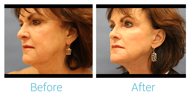 Facelift Before & After Gallery - Patient 58152101 - Image 2