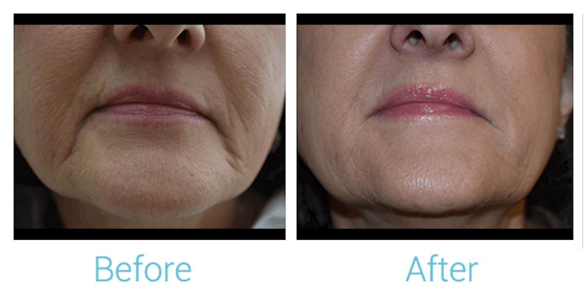 Fillers Before & After Gallery - Patient 58152116 - Image 1