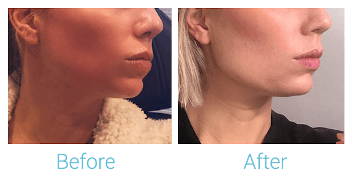 Fillers Before & After Gallery - Patient 58152117 - Image 1