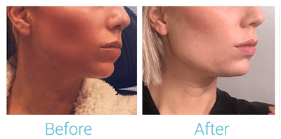 Fillers Before & After Gallery - Patient 58152117 - Image 1
