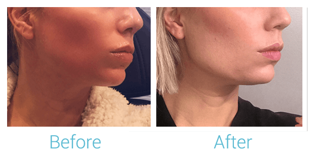 Face Filler Before & After Gallery - Patient 58152117 - Image 1