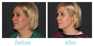 Fillers Before & After Gallery - Patient 58152118 - Image 1