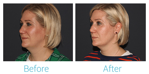 Face Filler Before & After Gallery - Patient 58152118 - Image 1