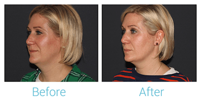 Face Filler Before & After Gallery - Patient 58152118 - Image 1