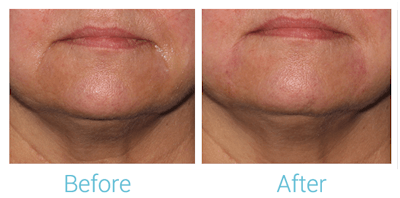 Fillers Before & After Gallery - Patient 58152119 - Image 1