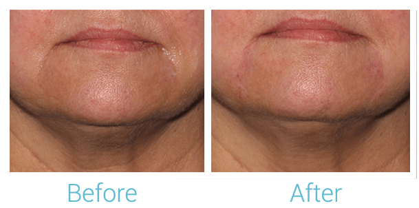 Face Filler Before & After Gallery - Patient 58152119 - Image 1