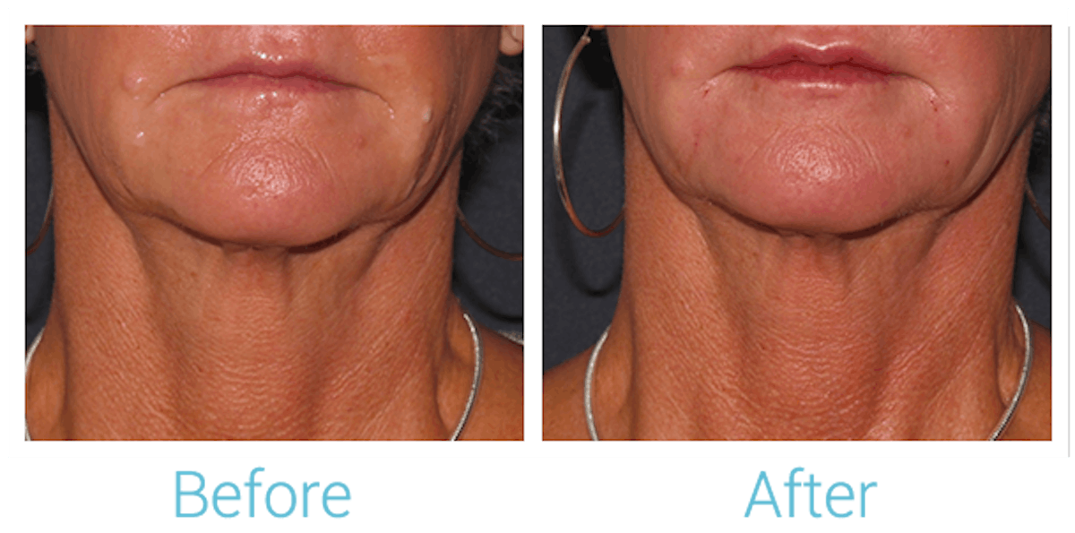Fillers Before & After Gallery - Patient 58152120 - Image 1