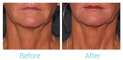 Face Filler Before & After Gallery - Patient 58152120 - Image 1