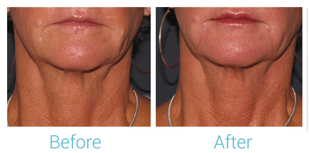 Face Filler Before & After Gallery - Patient 58152120 - Image 1