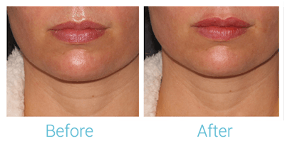 Face Filler Before & After Gallery - Patient 58152121 - Image 1