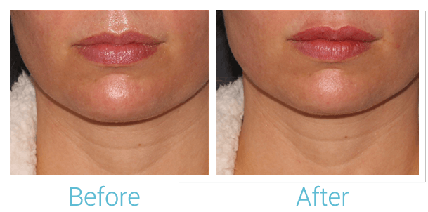 Face Filler Before & After Gallery - Patient 58152121 - Image 1