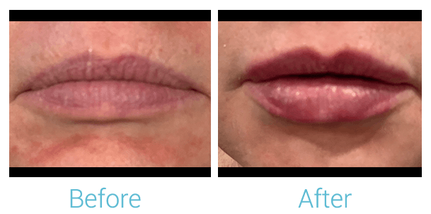 Face Filler Before & After Gallery - Patient 58152122 - Image 1