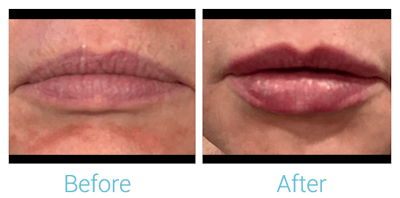 Face Filler Before & After Gallery - Patient 58152122 - Image 1