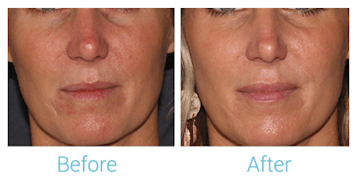 Fillers Before & After Gallery - Patient 58152123 - Image 1