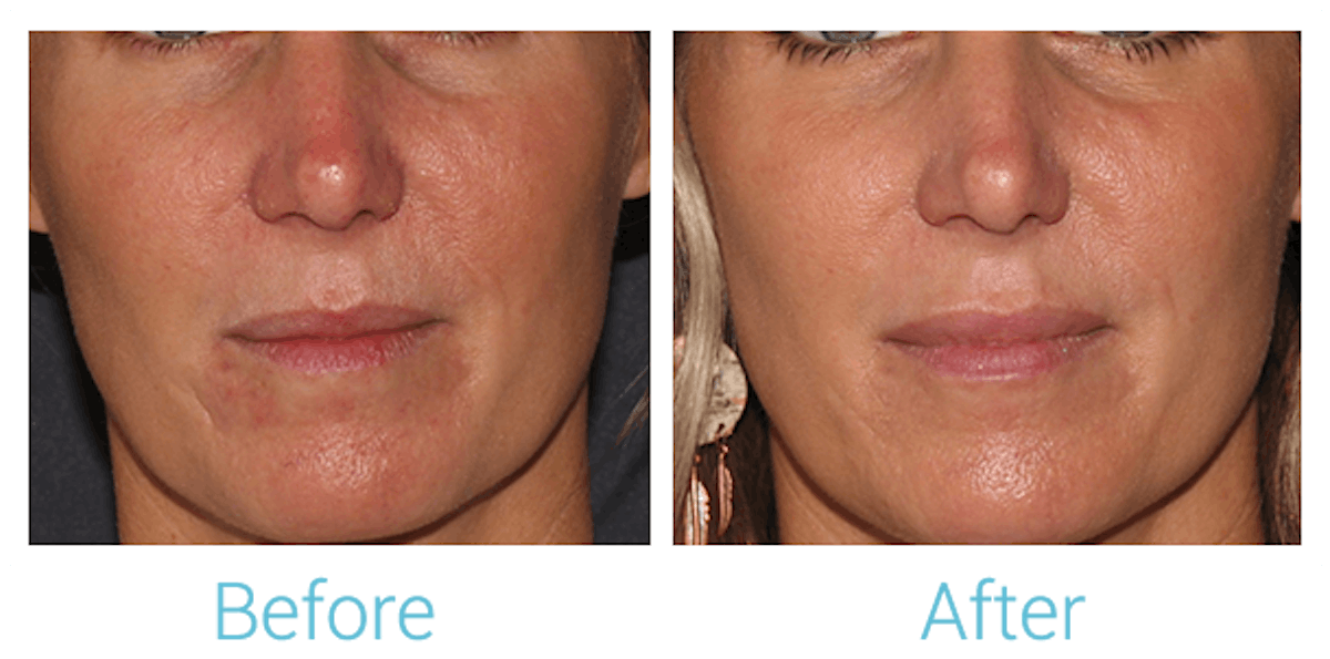 Fillers Before & After Gallery - Patient 58152123 - Image 1