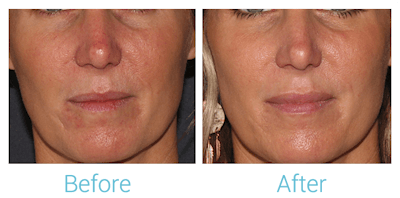 Face Filler Before & After Gallery - Patient 58152123 - Image 1