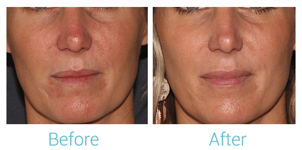 Face Filler Before & After Gallery - Patient 58152123 - Image 1