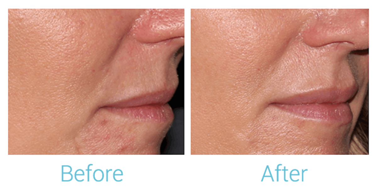 Fillers Before & After Gallery - Patient 58152124 - Image 1