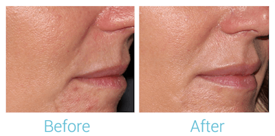 Face Filler Before & After Gallery - Patient 58152124 - Image 1