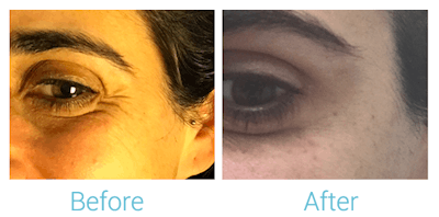Fillers Before & After Gallery - Patient 58152125 - Image 1