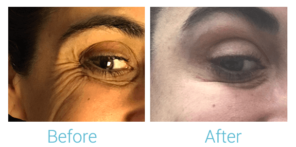 Face Filler Before & After Gallery - Patient 58152125 - Image 2