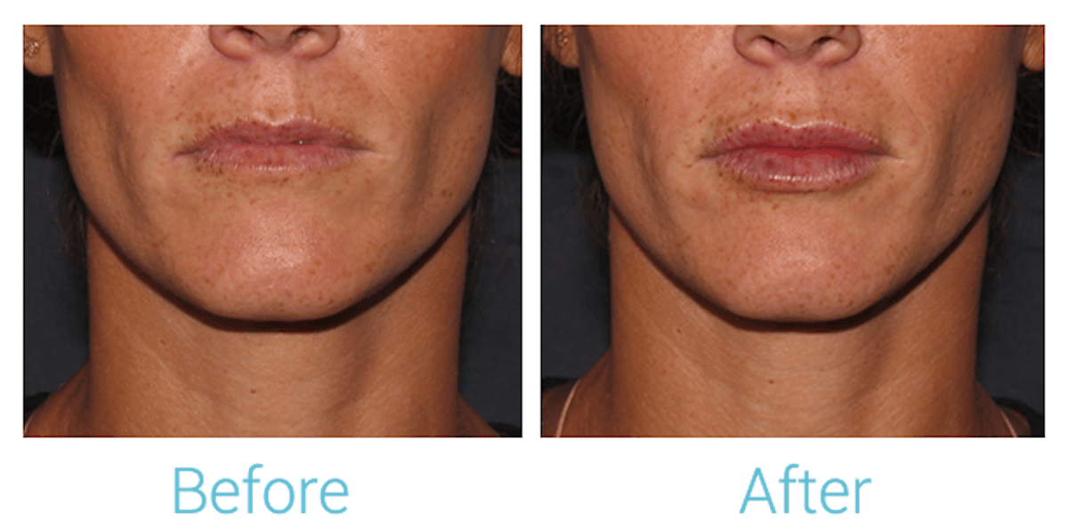 Fillers Before & After Gallery - Patient 58152126 - Image 1