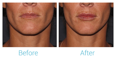 Fillers Before & After Gallery - Patient 58152126 - Image 1