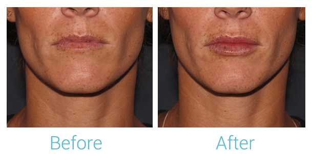 Face Filler Before & After Gallery - Patient 58152126 - Image 1