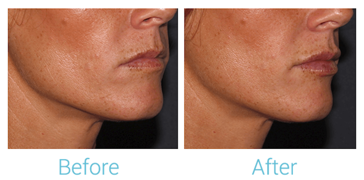 Fillers Before & After Gallery - Patient 58152126 - Image 2