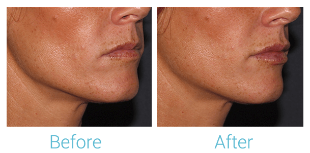 Face Filler Before & After Gallery - Patient 58152126 - Image 2
