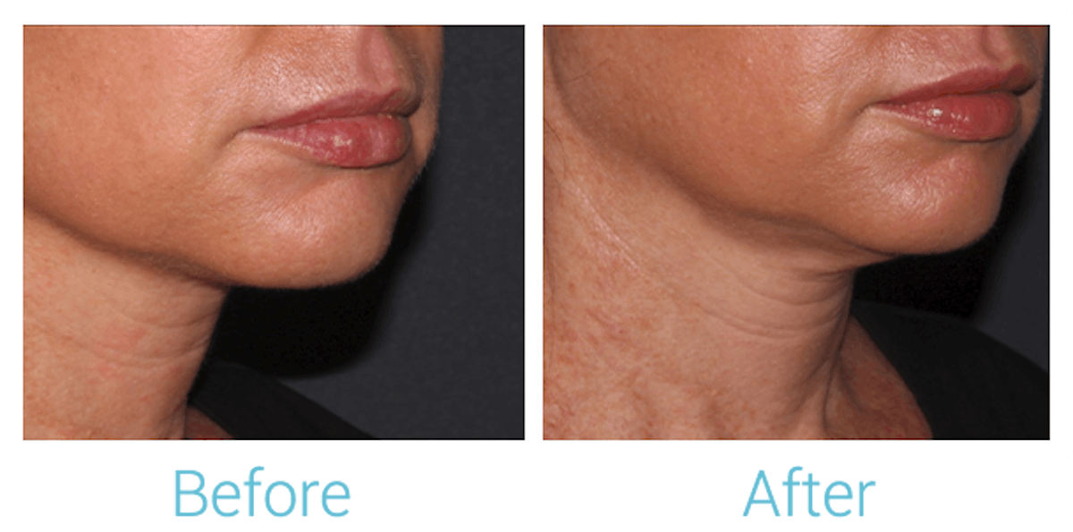 Fillers Before & After Gallery - Patient 58152127 - Image 2