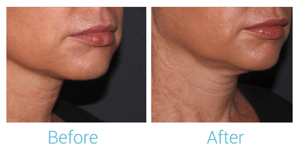 Face Filler Before & After Gallery - Patient 58152127 - Image 2