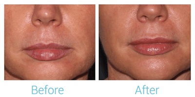 Fillers Before & After Gallery - Patient 58152127 - Image 1