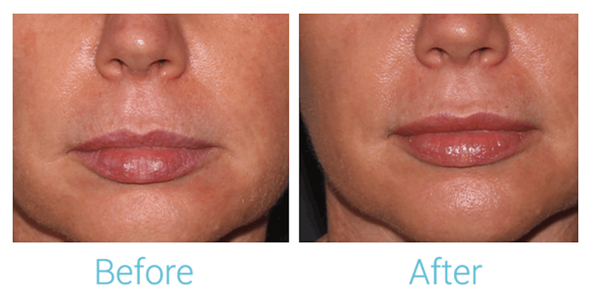 Fillers Before & After Gallery - Patient 58152127 - Image 1