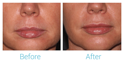Face Filler Before & After Gallery - Patient 58152127 - Image 1