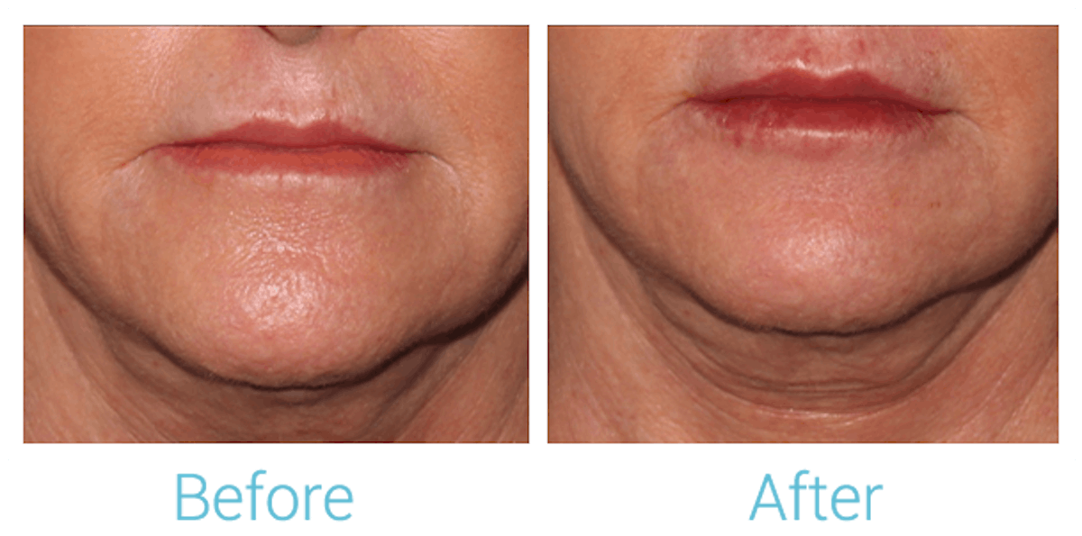 Fillers Before & After Gallery - Patient 58152128 - Image 1