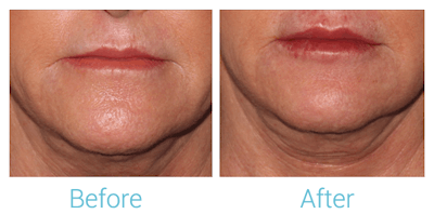 Fillers Before & After Gallery - Patient 58152128 - Image 1