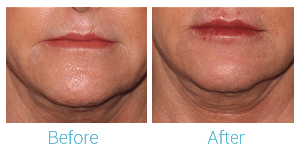 Face Filler Before & After Gallery - Patient 58152128 - Image 1