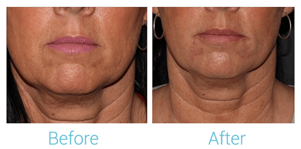 Fillers Before & After Gallery - Patient 58152129 - Image 1