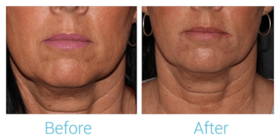 Face Filler Gallery - Patient 58152129 - Image 1