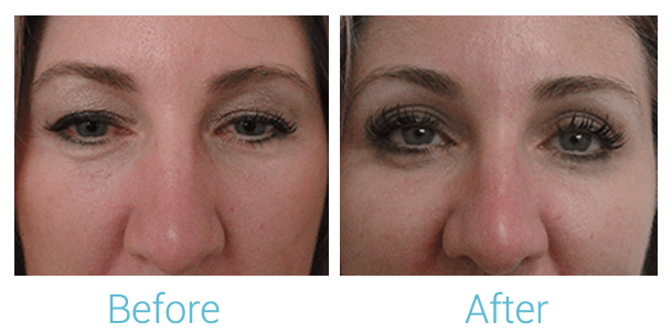 Ultherapy Before & After Gallery - Patient 58152132 - Image 1