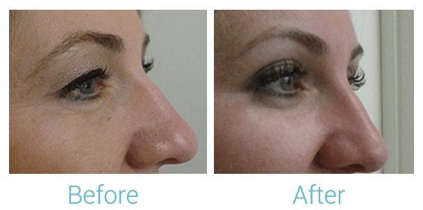 Ultherapy Before & After Gallery - Patient 58152132 - Image 2