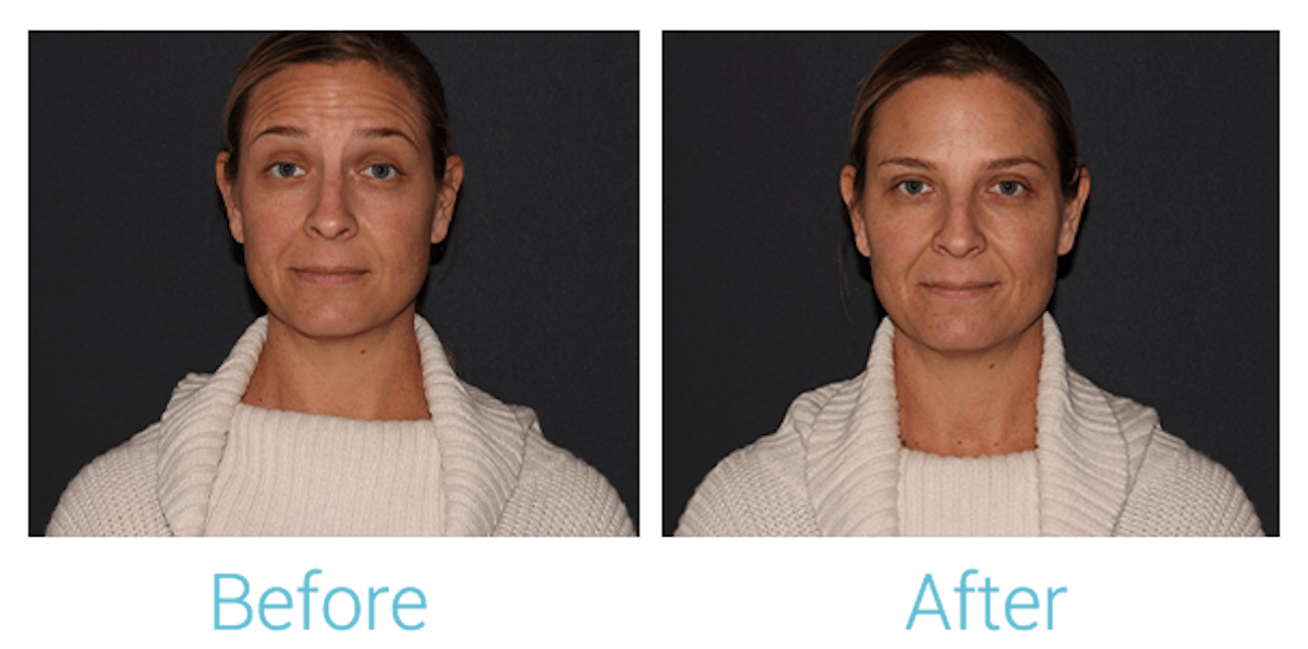 Neurotoxins (Botox, Dysport, Xeomin) Before & After Gallery - Patient 58152149 - Image 1