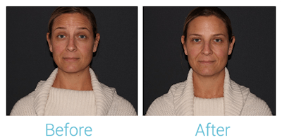 Neurotoxins (Botox, Dysport, Xeomin) Before & After Gallery - Patient 58152149 - Image 1