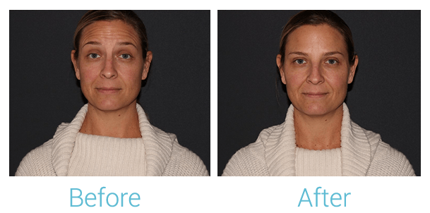 Dysport Before & After Gallery - Patient 58152138 - Image 1