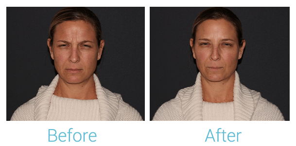 Botox Before & After Gallery - Patient 58152149 - Image 2