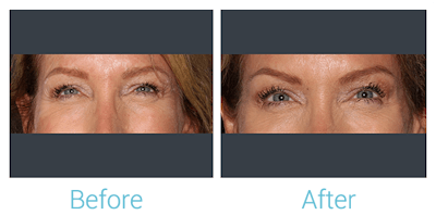 Fillers Before & After Gallery - Patient 141444131 - Image 1