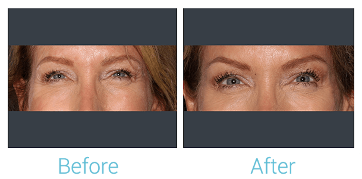 Neurotoxins (Botox, Dysport, Xeomin) Before & After Gallery - Patient 58152150 - Image 1